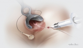 Biodesign® Fistula Plug
