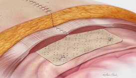 Biodesign® Hernia Graft