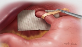 Biodesign® Hiatal Hernia Graft