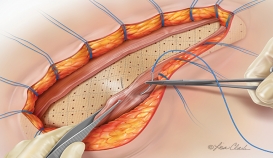 Biodesign® Incision Graft