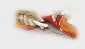 Novapass® Suture Passer