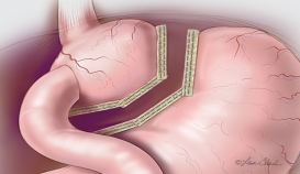 Biodesign® Staple Line Reinforcement