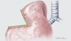 Biodesign® Staple Line Reinforcement