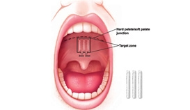 Treatments for Sleep-Disordered Breathing